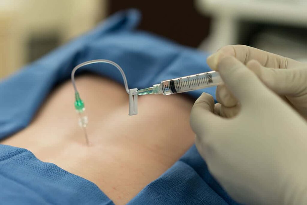 What is an Epidural Shot?